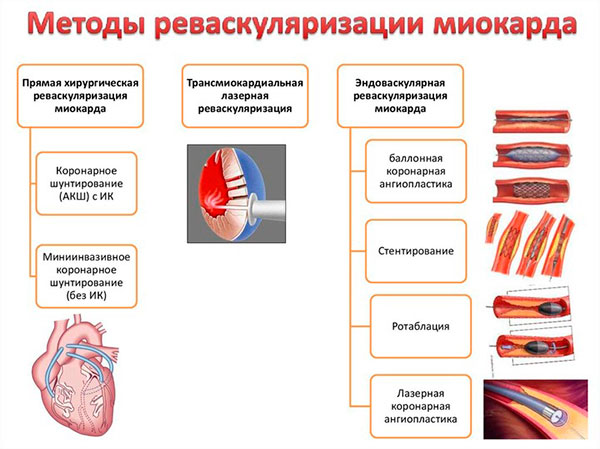 Методы прямой реваскуляризации миокарда